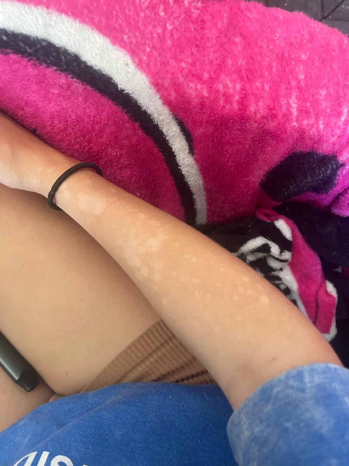 White spots in my skin on my forearm that have appeared randomly over the last few months