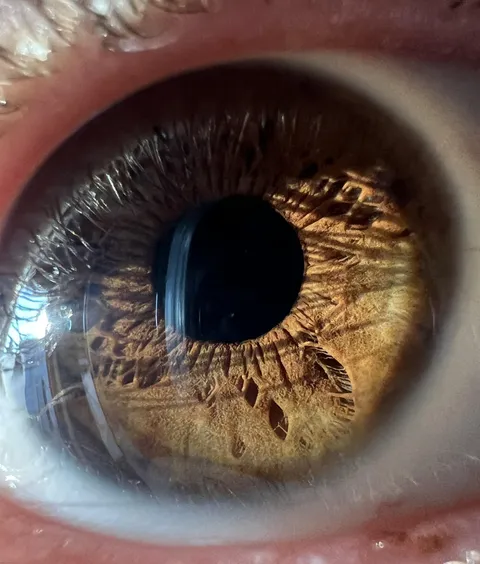 I have the shape and texture of a feather at the bottom of my iris 