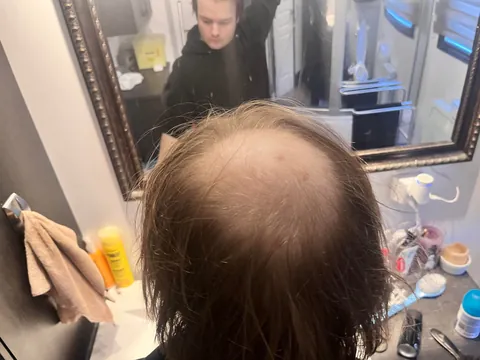 I am balding since I’m 14y/o