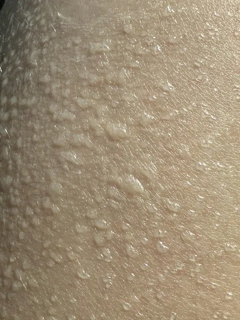 Sweat became trapped under a peeling sunburn.