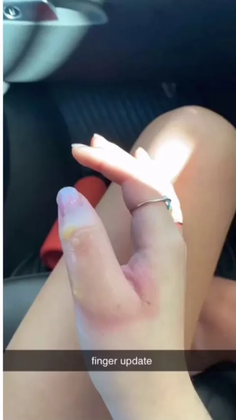 The healing of her burn blister 
