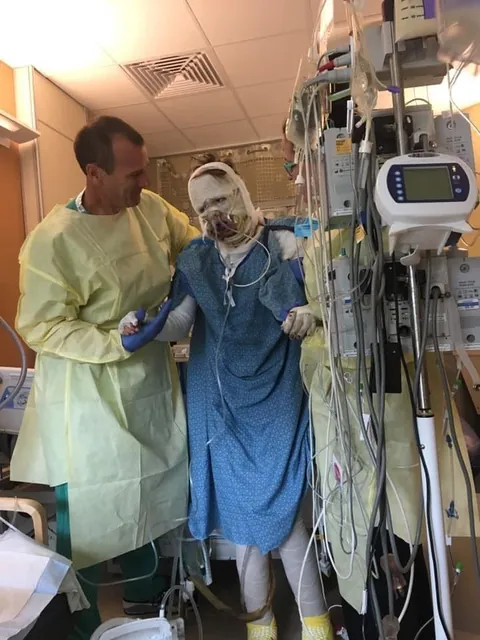 Almost 6 years post burn!!