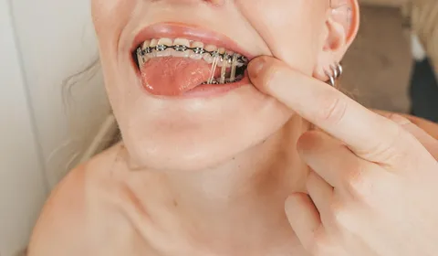 The only thing better than 3 elastics each side is 4 elastics each side