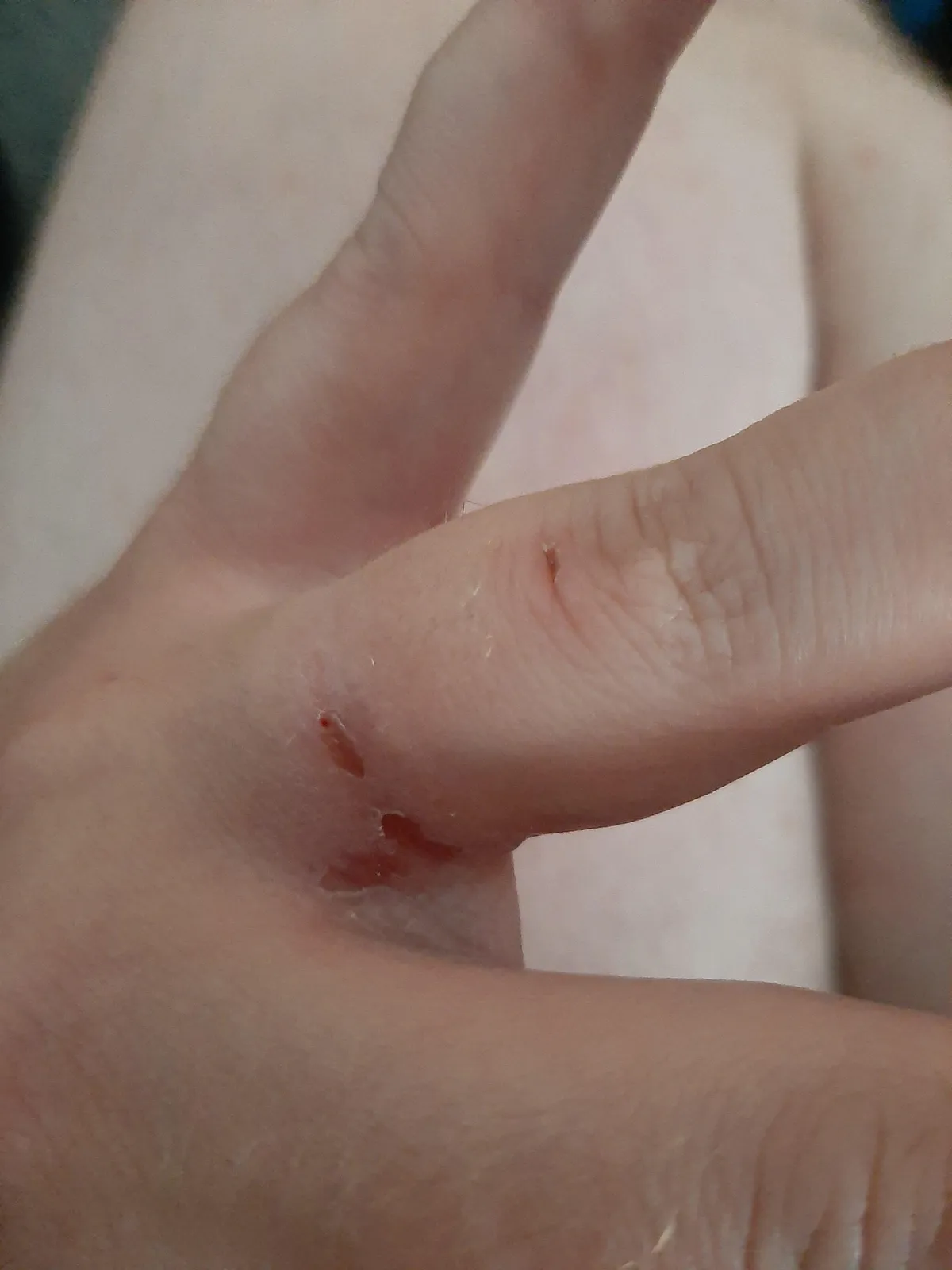 Took my ring off after 15 years.