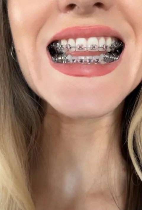 Cheesy braces smiles are the cutest, change my mind