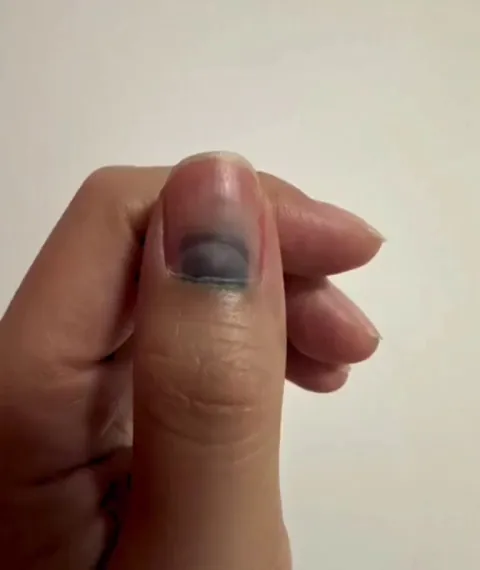 Time-lapse of a nail regrowing after it was injured