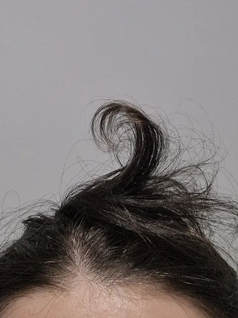 My hair regrowth after alopecia makes me smile at how wild it is [OC]