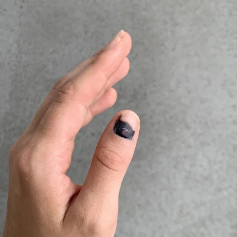 I closed my car door on my thumb