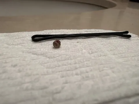 This blackhead that came out of a pimple on my arm is big