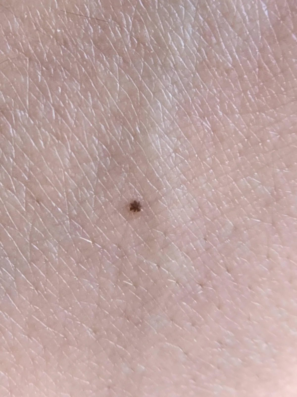 This tiny freckle on my hand looks like an asterisk *