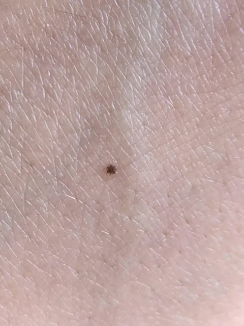 This tiny freckle on my hand looks like an asterisk *