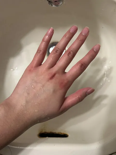 Why do my fingers turn red from the knuckles when I wash them with warm water? What's actually happening in (or on?) my hands?