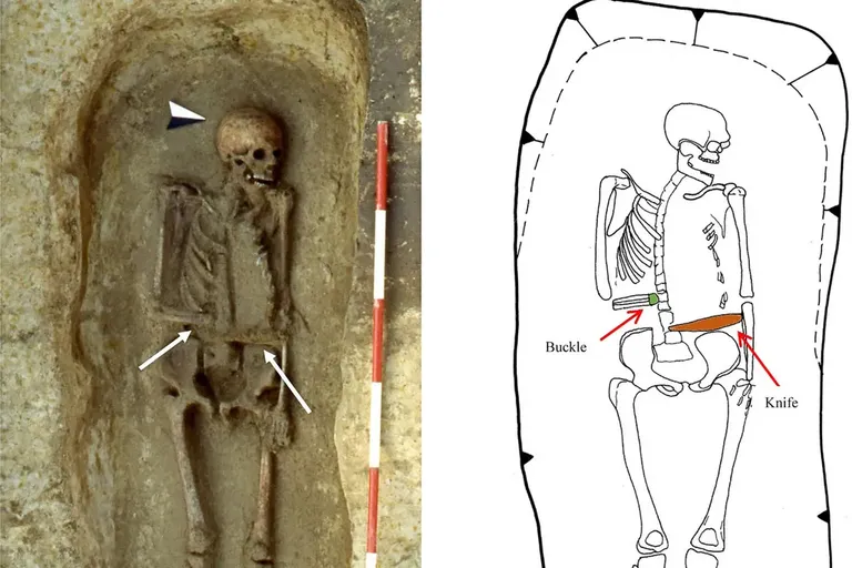 A photo of the remains of a man from Medieval times that showed that he used a knife for a prosthetic limb. Source for the information located in the comment section.