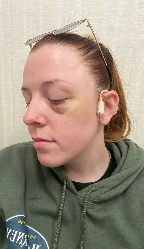 Massive Black Eye Cover Up Before &amp; After