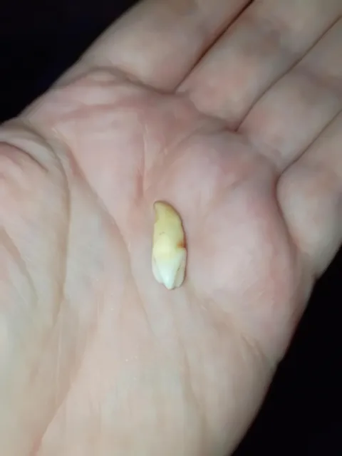 tooth grew at the roof of my mouth finally got removed