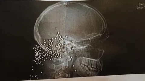 A rather “rural” patient came in with new-onset seizures. CT reveals small metal pellets in head. Patient states his wife accidentally shot him several years ago while trying to get a raccoon off their property.