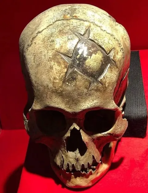 An early example of a successful cranioplasty (Peru, ca. 400 CE). The patient survived, as evidenced by the well-healed in situ cranioplasty made from a gold inlay.