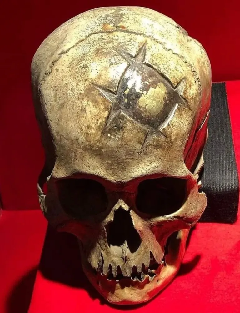 An early example of a successful cranioplasty (Peru, ca. 400 CE). The patient survived, as evidenced by the well-healed in situ cranioplasty made from a gold inlay.