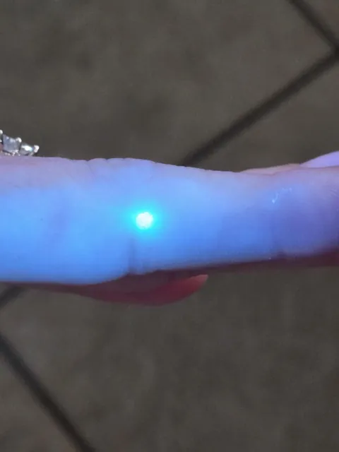 My fiance has a spot that glows green under UV light.