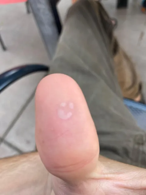 My friend burnt his thumb on a hot philips head screw.