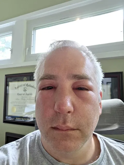 Got stung by a bee on my nose and now I look like I lost a boxing match.