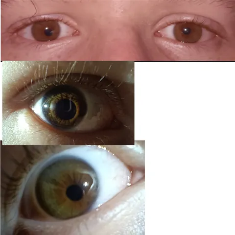 My pupils arent in the center of my eyes.