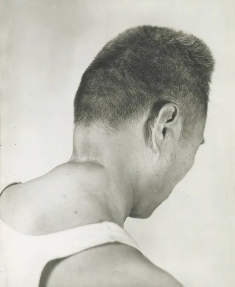 A filipino survivor of the Manila massacre, shows where a Japanese officer tried to behead him, 1945.