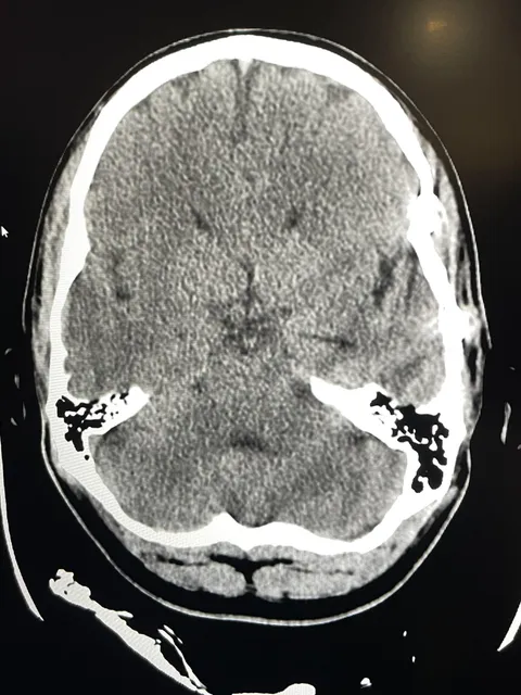 Picture of my skull after being hit with brass knuckles