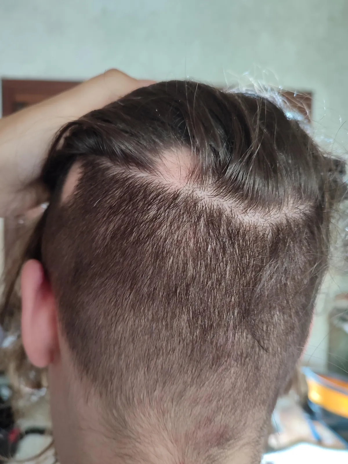 After years of having short hair, I decided to let it grow on top, and it’s been almost a year. Now, alopecia areata kicked in