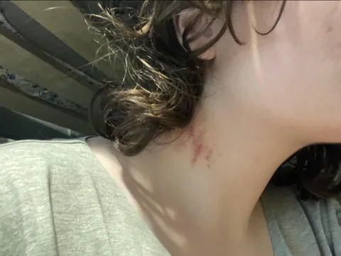 How do I convince people this wasn’t a hickey?