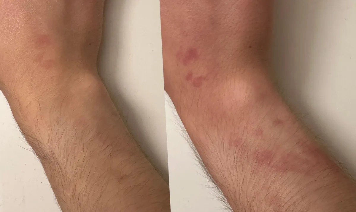 I have a birthmark that gets more visible when I am stressed