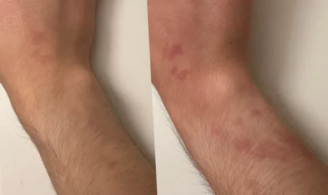 I have a birthmark that gets more visible when I am stressed