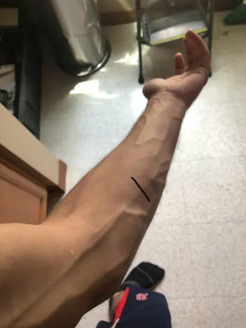 The way my veins rerouted around the section that collapsed