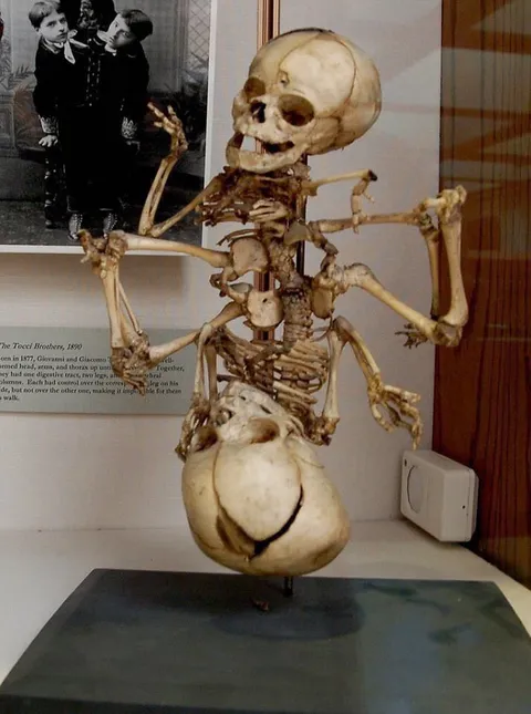Skeleton of siamese twins