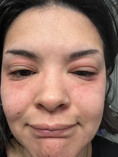 Watch my eyes blow up from the arnica in my concealer