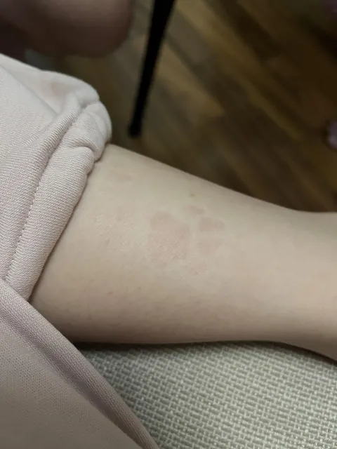 Paw print from my cat sitting on me for 5 minutes.