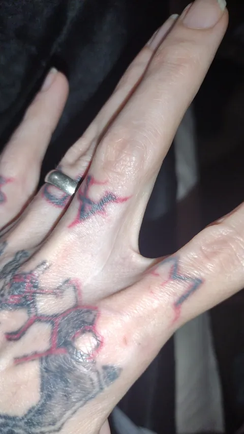 Orthopedic surgeon reattached my finger bone rotated a few degrees so I can't close it or grip