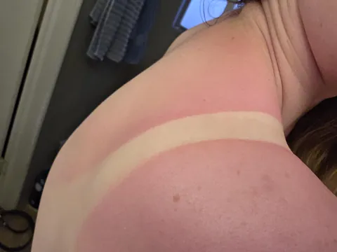 Spontaneous College class field trip caused a major sunburn