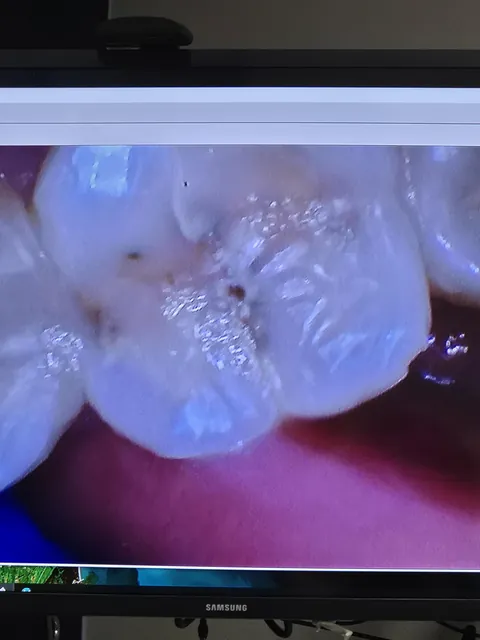 Dentist botched ny cavity filling; now I need two root canals