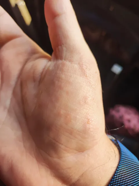 My dermatitis has evolved in just four days, and it only appears when I'm particularly stressed, always in the same spot. It's so itchy, it's a nightmare to work with.