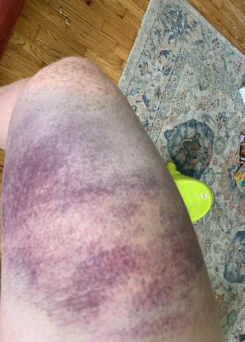 Spent the last two months exercising, eating well, getting in shape. Sunday was my first organized soccer game in ten years. 35 minutes in and I partially tore my quad. Shit.