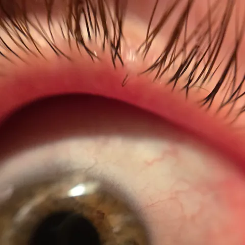 Despite seeing multiple docs, my eye watered excessively for 7 years until I took this picture