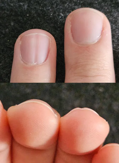 My ring fingernail grows with a permanent groove in it
