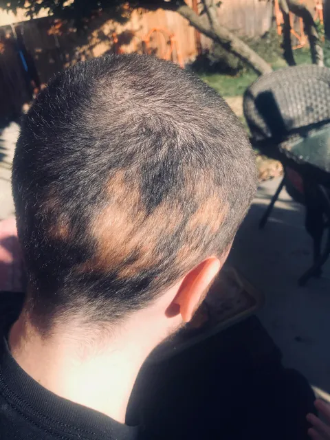 My son has a blonde birthmark