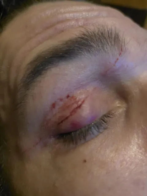 Cat slipped whilst walking across my face at 4am, almost completely through my eye lid in one spot. Happy birthday, ha.