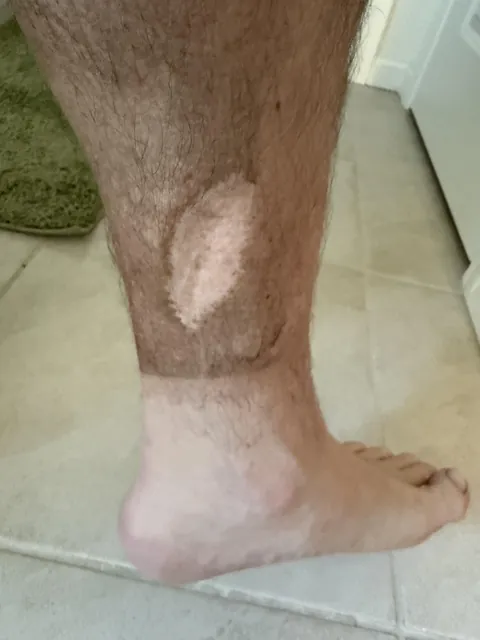 My husband broke his leg when he was younger and got a skin graft; it doesn’t tan or collect dirt like the rest of his leg.