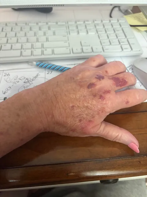 I am 70 and I’m sick of these bruises