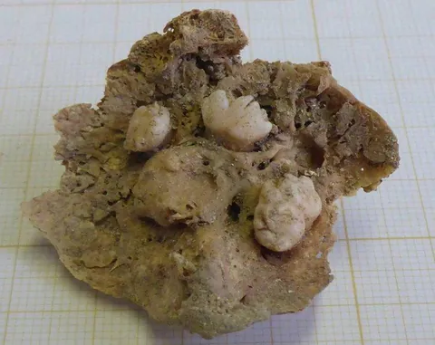 A 1,600-year-old ovarian teratoma found in a Roman woman’s pelvis. It grew its own teeth and bone.
