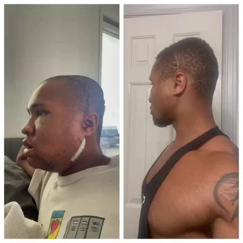 Following facial reconstruction surgery, the face tends to swell excessively. This swelling can take a year to subside, with most of it going away within the first 6 months. Here’s me 4 days vs 4 months post-op