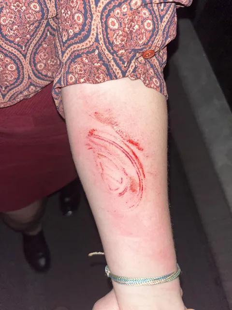 My girlfriend was branded by her VW airbag